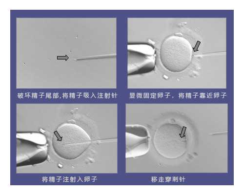 试管放几个胚胎谁决定,35岁以上试管移植放几个