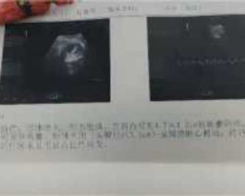 借卵试管代生-囊胚12天白板确定没希望了吧，囊胚12天白板验血